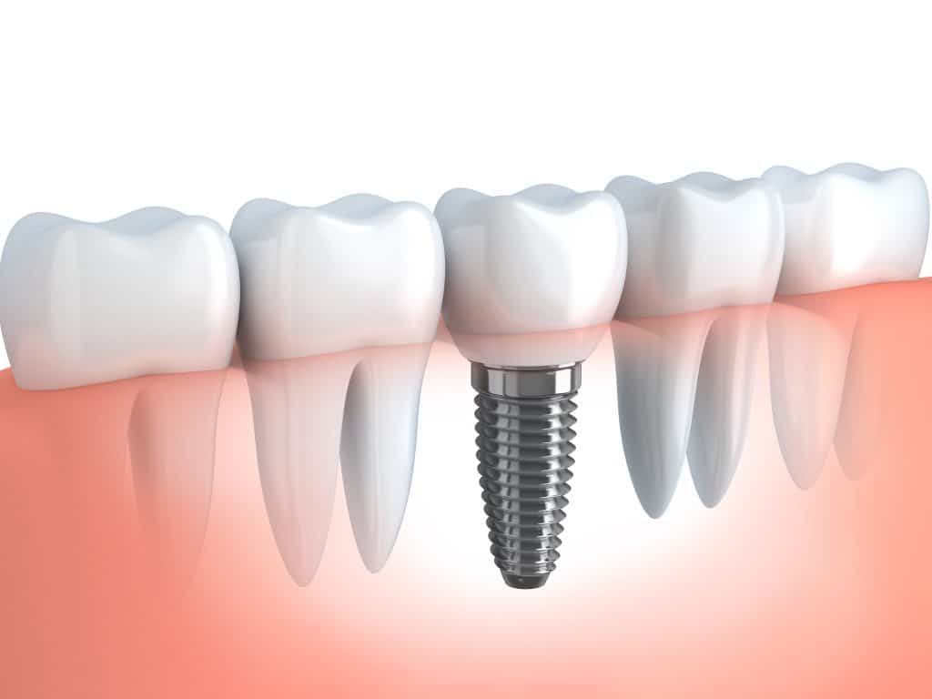 Fitting the dental implant
