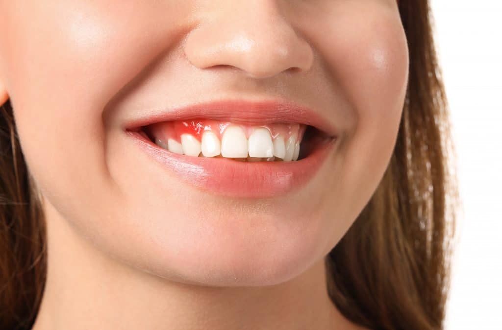 swollen gums showing gum disease