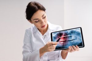 Impacted Wisdom Teeth