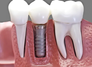 Dental Implant Surgery