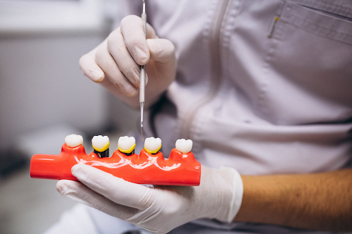 Dental Crown Implant