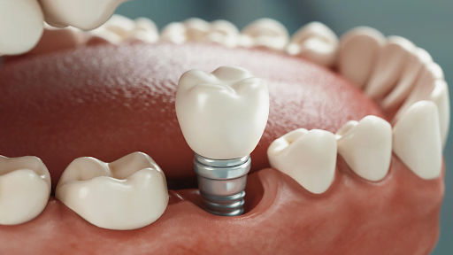 The dental implant procedure