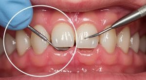 Gum Recession Causes, Prevention, and Treatment by Glen Iris Dentists