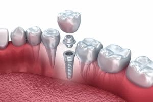 dental implant cost in ashburton